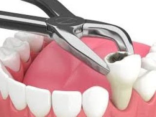Dental Extractions Near Me