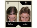 how-to-choose-the-right-treatment-of-hair-restoration-for-women-small-0