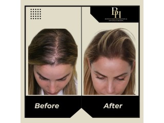 How to Choose the Right Treatment of Hair Restoration for Women