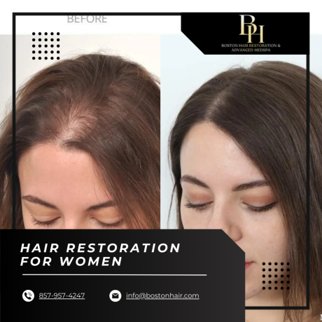 how-to-choose-the-right-treatment-of-hair-restoration-for-women-big-1