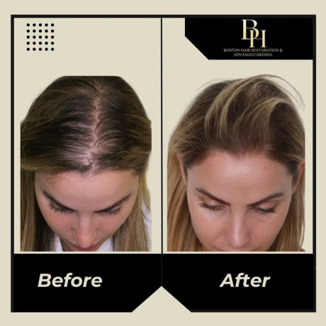 how-to-choose-the-right-treatment-of-hair-restoration-for-women-big-0
