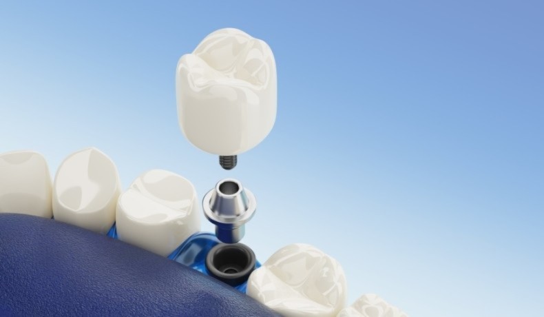restore-your-smile-with-dental-implants-near-me-big-0