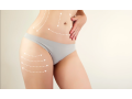 best-liposuction-clinic-in-dubai-small-1