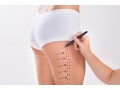 best-liposuction-clinic-in-dubai-small-4