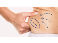 best-liposuction-clinic-in-dubai-small-2
