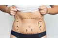 best-liposuction-clinic-in-dubai-small-3