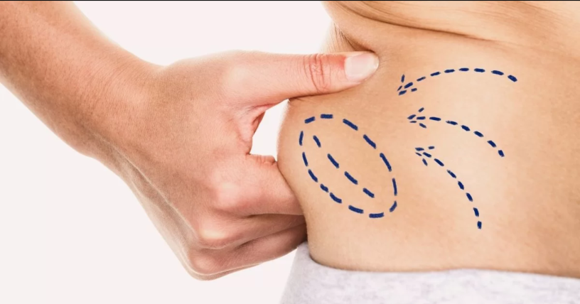 best-liposuction-clinic-in-dubai-big-2