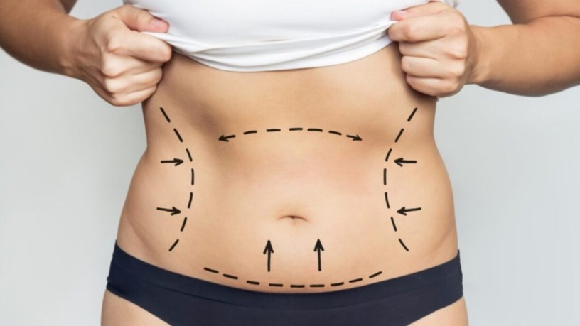 best-liposuction-clinic-in-dubai-big-3