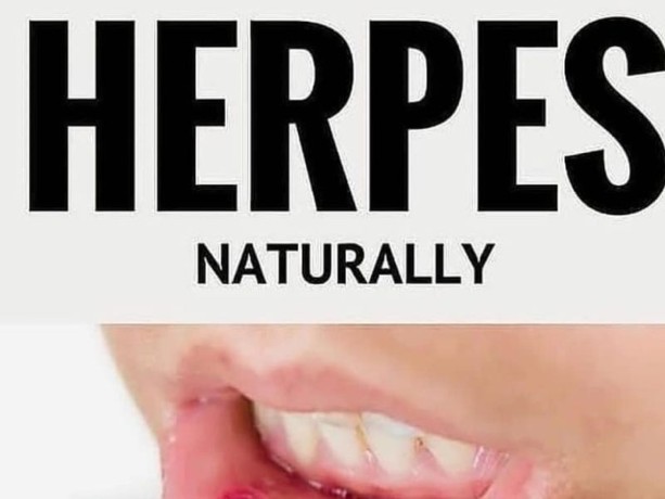 how-to-cure-herpes-12-naturally-big-1